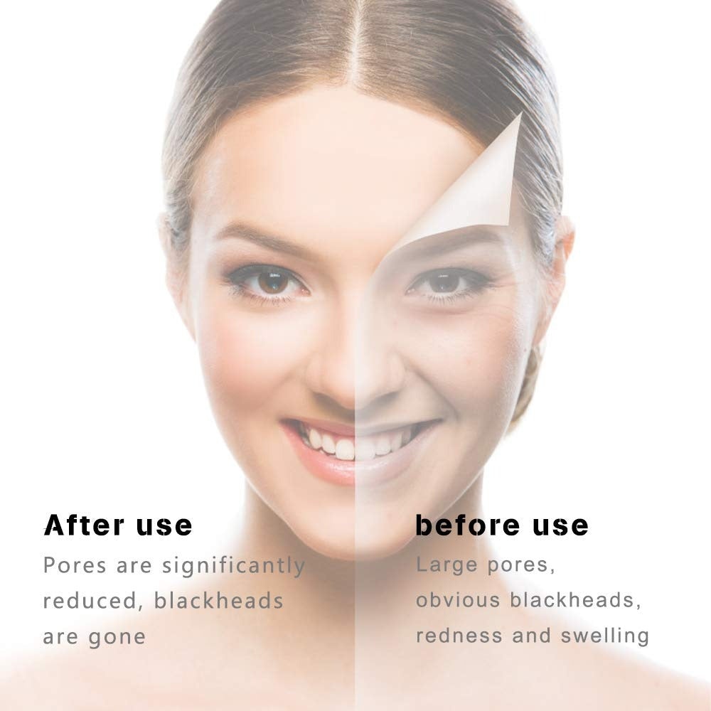 ClearGlow Blackhead Remover